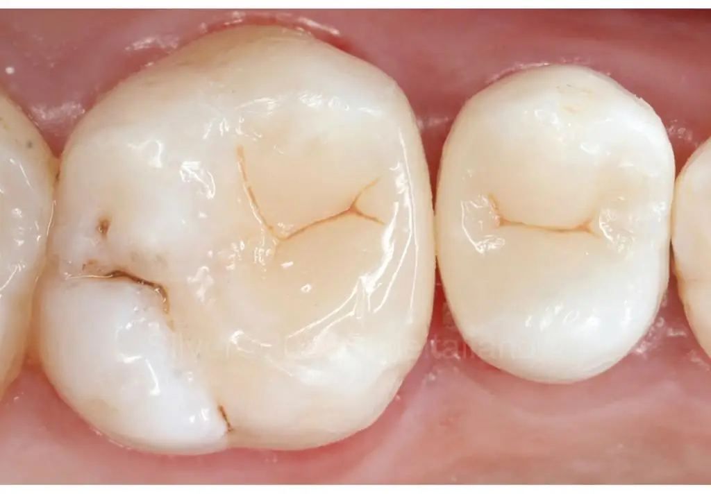 Why is Good Dental Filling a Lost Art Among Most Dentists