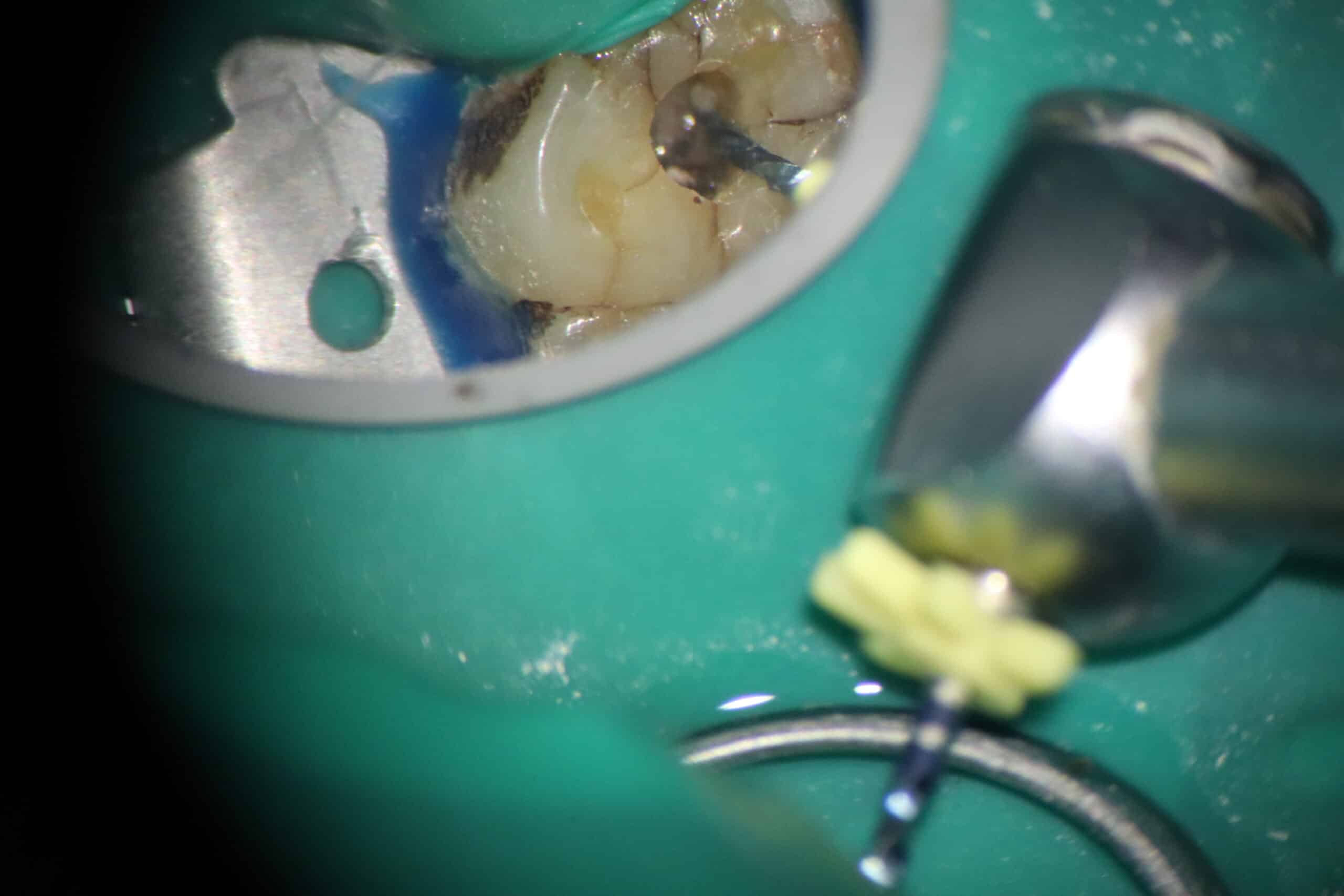 Dental microscope used for root canal retreatment at Redefine Dental Clinic, Kalyan West