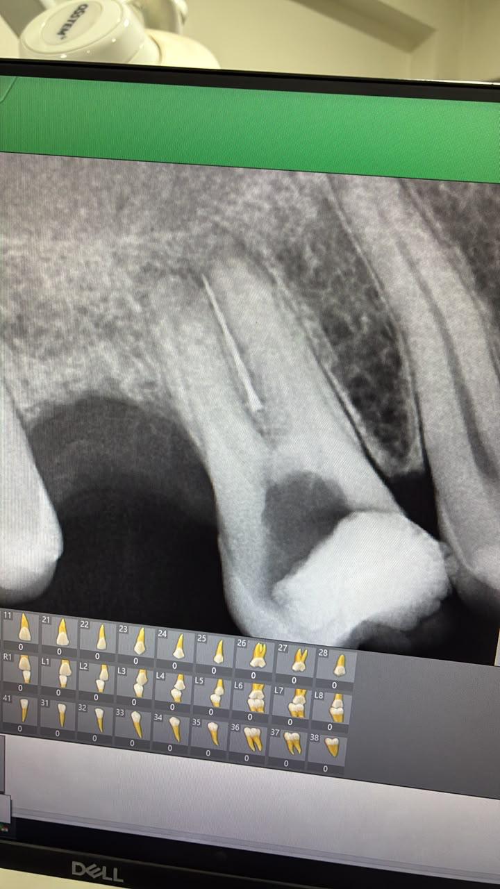 microscope-guided, biomimetic dentistry at Redefine Dental Clinic Kalyan