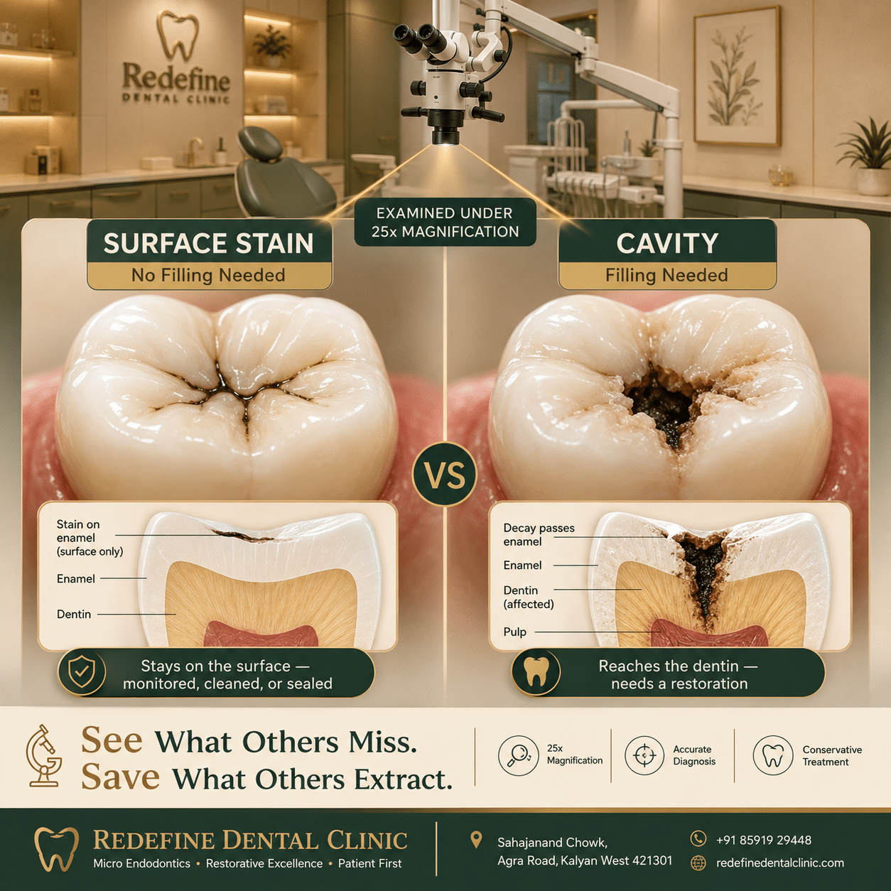 Comparison of a harmless black surface stain versus a true cavity needing a filling, examined under a dental operating microscope